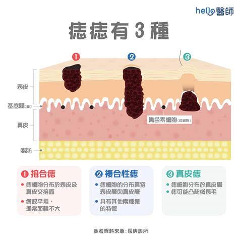 身體很多痣|痣形成的原因？痣長毛、痣變多變大是痣病變？5招判別